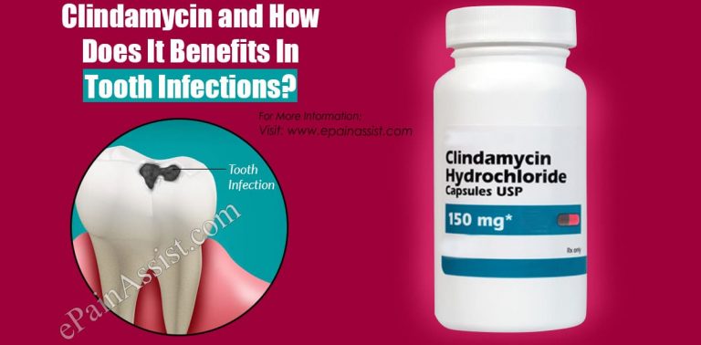 Clindamycin for Tooth Infections: Benefits, Side Effects, Dosage, Allergic Reactions
