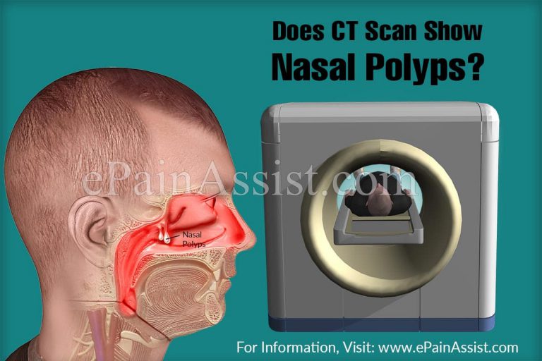 Does CT Scan Show Nasal Polyps?