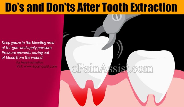 Do’s and Don’ts After Tooth Extraction