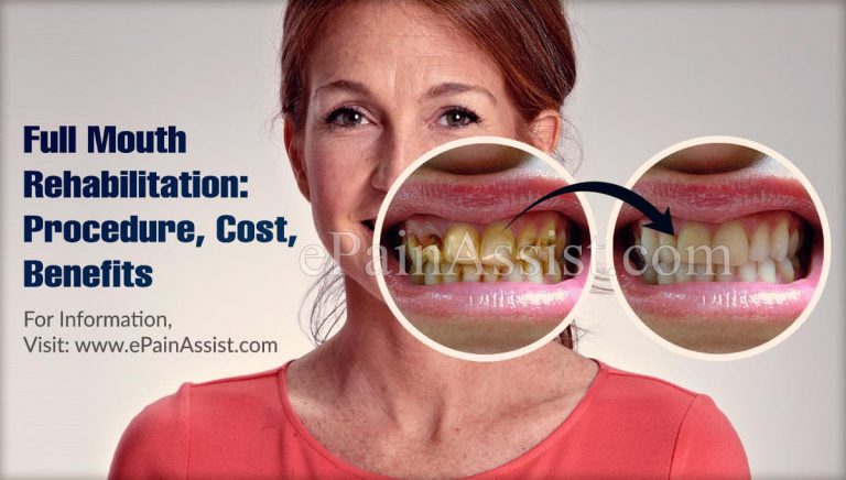 Full Mouth Rehabilitation: Procedure, Cost, Benefits, How Long Does Full Mouth Rehabilitation Procedure Take