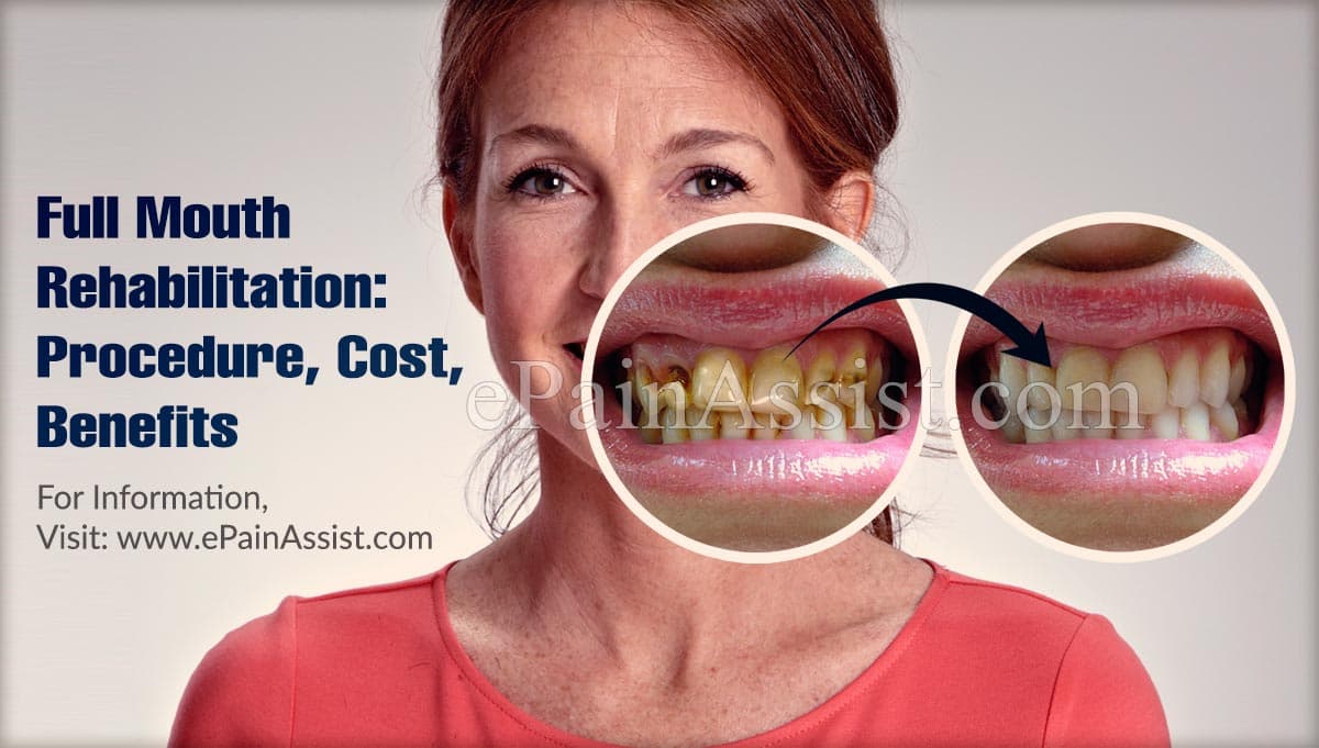 Full Mouth Rehabilitation: Procedure, Cost, Benefits