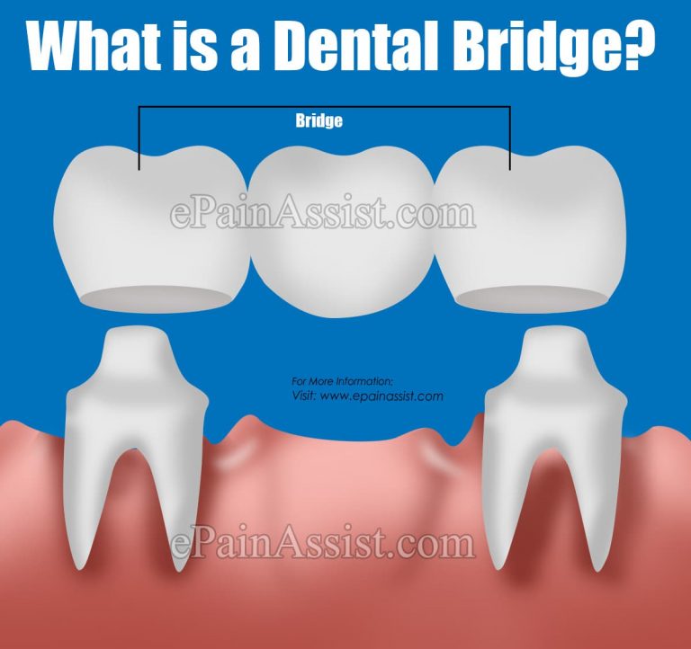 How is Dental Bridge Treatment for Missing Teeth Done, Know its Costs, Benefits?