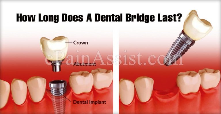 How Long Does A Dental Bridge Last?