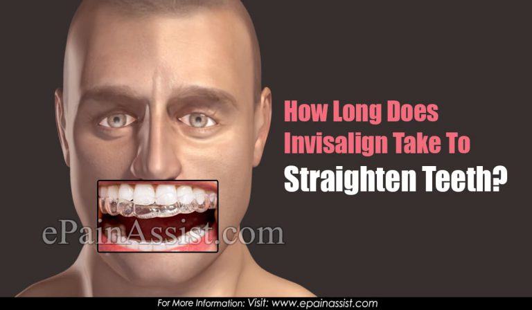 How Long Does Invisalign Take to Straighten Teeth?