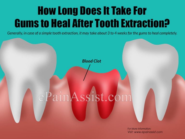 How Long Does It Bleed After Tooth Extraction & How to Stop the Bleeding?