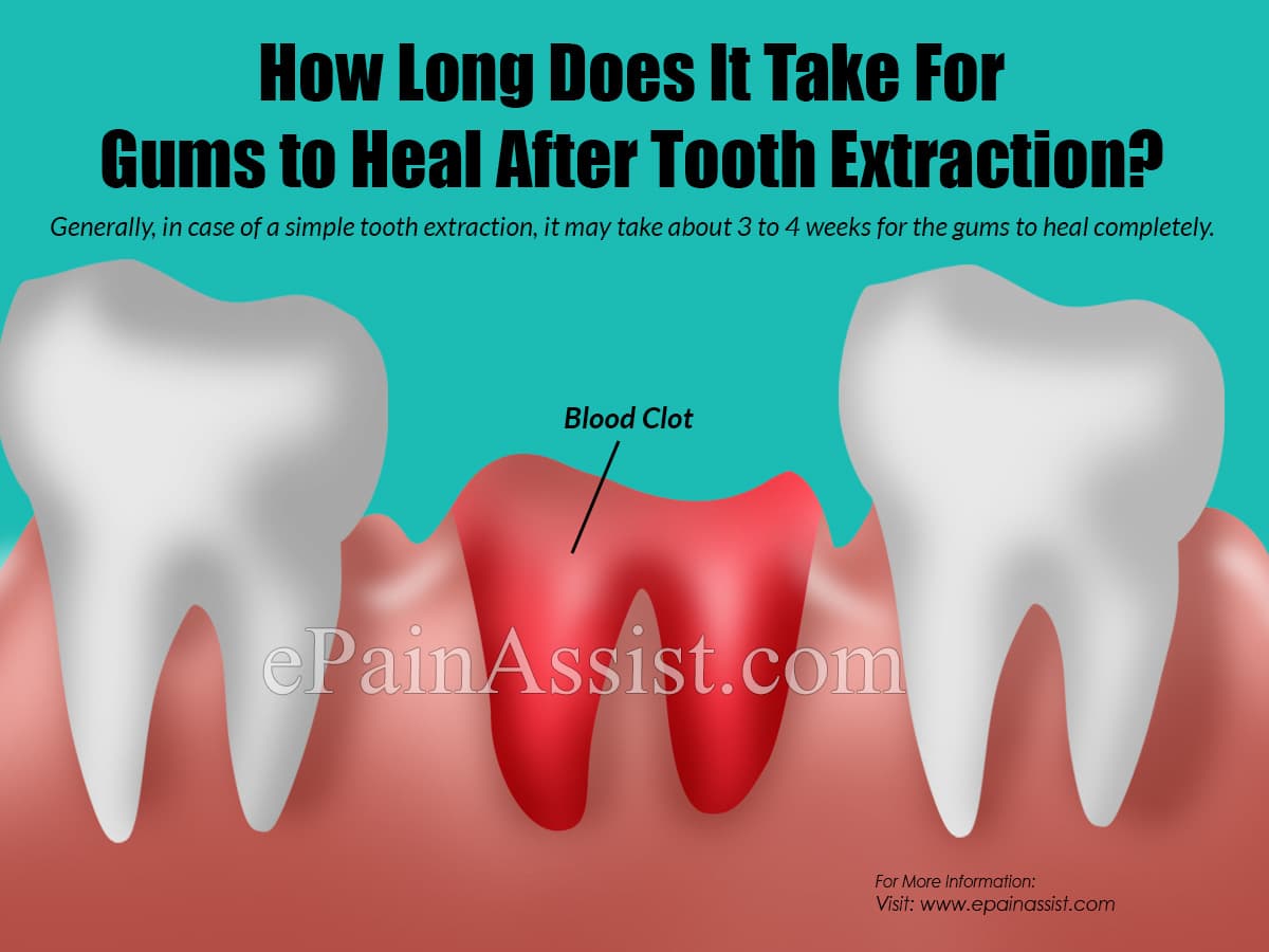 How Long Does It Bleed After Tooth Extraction?