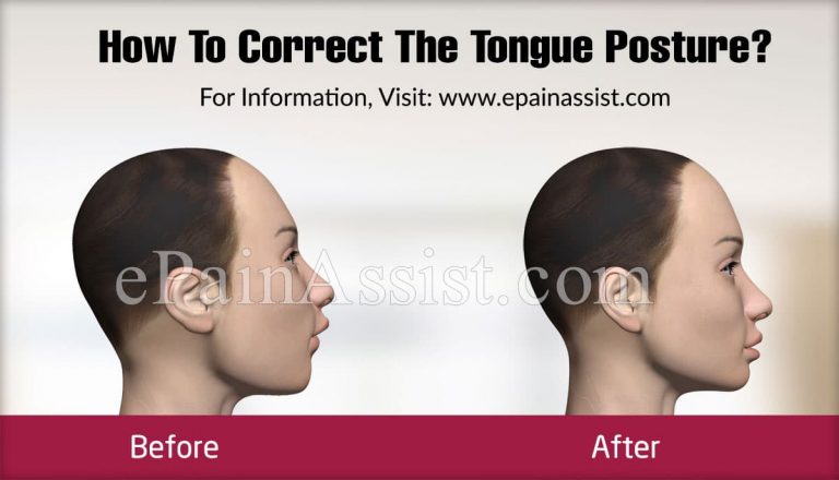 Problems Caused By Improper Tongue Posture & Ways To Correct The Tongue Posture