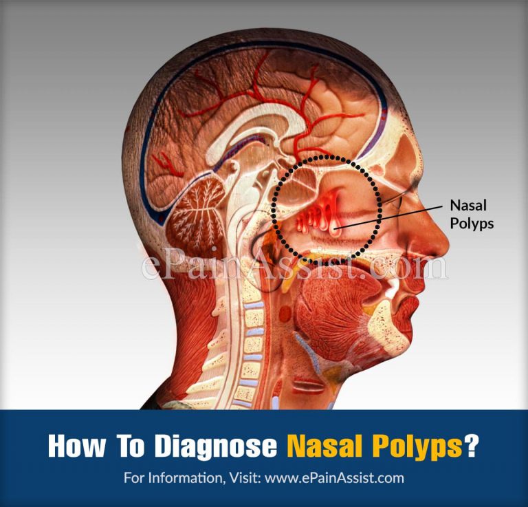 How To Diagnose Nasal Polyps And What Is The Best Medicine For It?