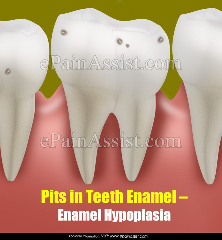 What Causes Pits In Teeth Enamel And How To Treat Them?