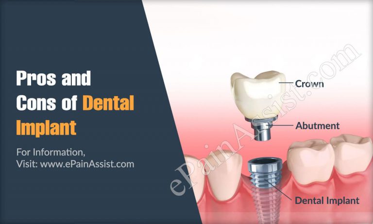 Pros and Cons of Dental Implant