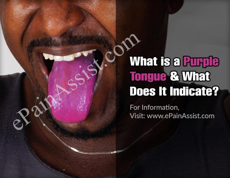 Purple Tongue: Causes, Symptoms, Treatment