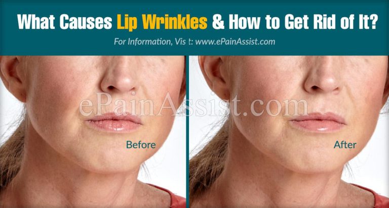 What Causes Lip Wrinkles & How to Get Rid of It?