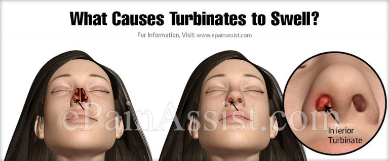 What Causes Turbinates to Swell & How Long Does It Take To Recover From Turbinate Reduction?