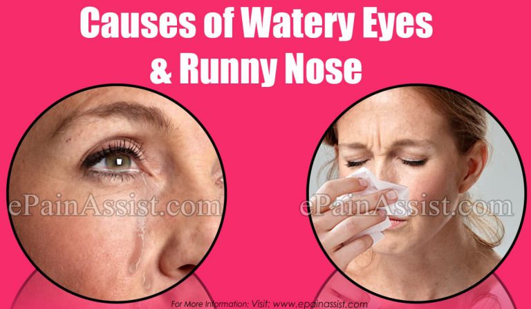 What Causes Watery Eyes and Runny Nose & What are its Treatment, Home Remedies