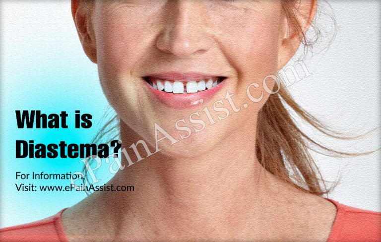 What Is Diastema: Causes, Symptoms, Treatment, Prognosis, Prevention