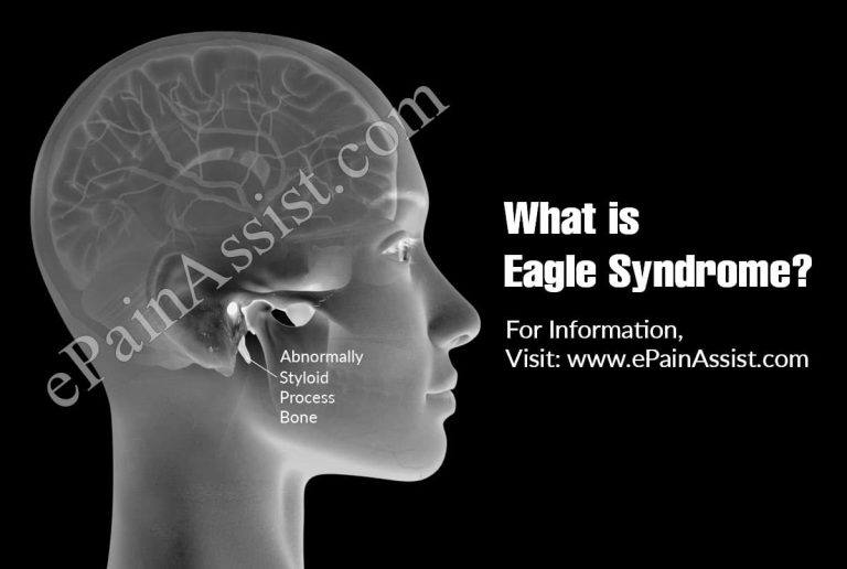 What is Eagle Syndrome: Causes, Symptoms, Treatment