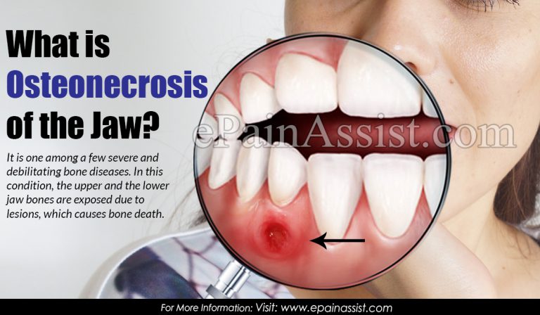 What is Osteonecrosis Of The Jaw: Causes, Symptoms, Treatment, Prognosis