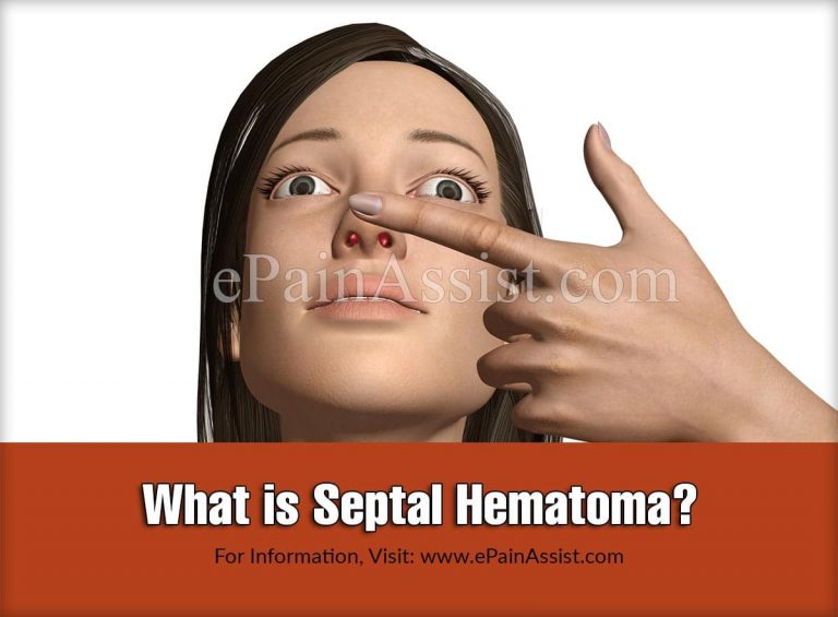 Septal Hematoma: Causes, Symptoms, Treatment, Diagnosis