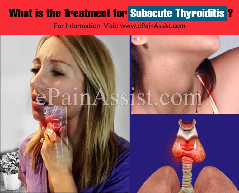 What is the Treatment for Subacute Thyroiditis?