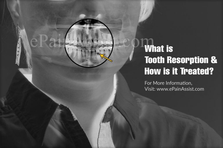 What is Tooth Resorption & How is it Treated?