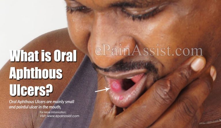 Oral Aphthous Ulcers: Types, Causes, Symptoms, Treatment, Duration, Prevention, Diagnosis