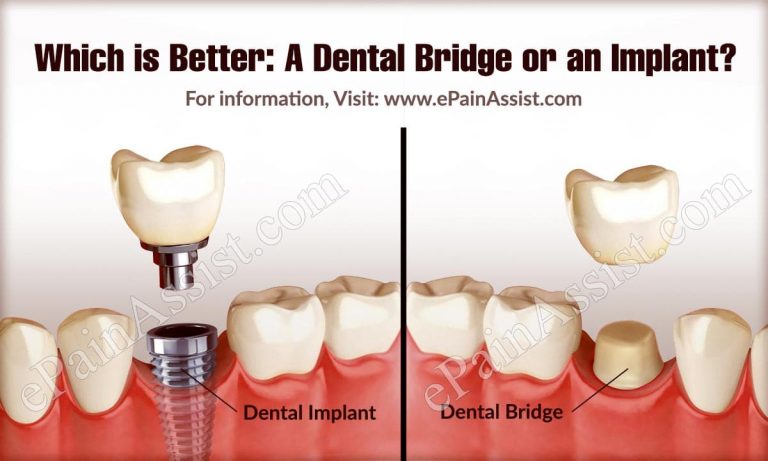 Which is Better: A Dental Bridge or an Implant?
