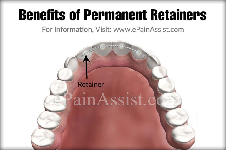 Permanent Retainers: Benefits & Drawbacks