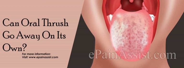 Can Oral Thrush Go Away On Its Own & What Are Its Natural Remedies?