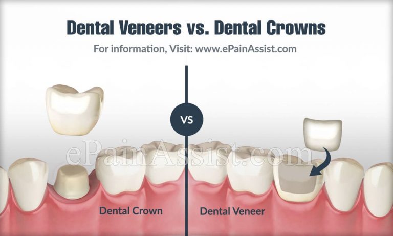 Dental Veneers vs. Dental Crowns: What is the Difference and Which One Should You Get?