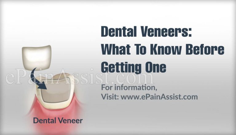 Dental Veneers: What To Know Before Getting One