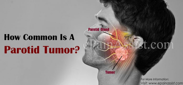 How Common Is A Parotid Tumor & What Is The Life Expectancy For Someone With It & Is There A Surgery For Parotid Tumor?