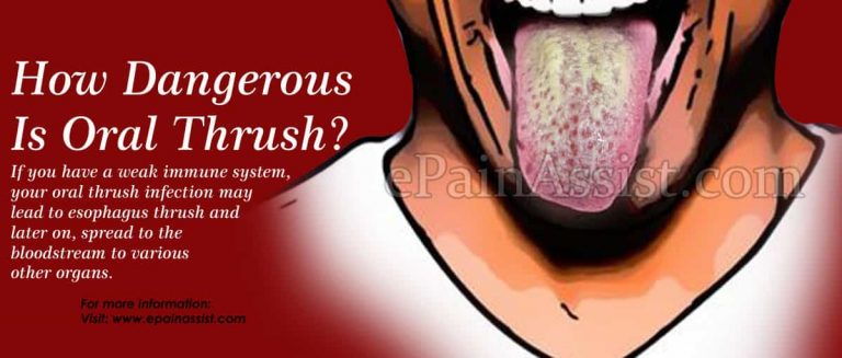 How Dangerous Is Oral Thrush & Is It Contagious?