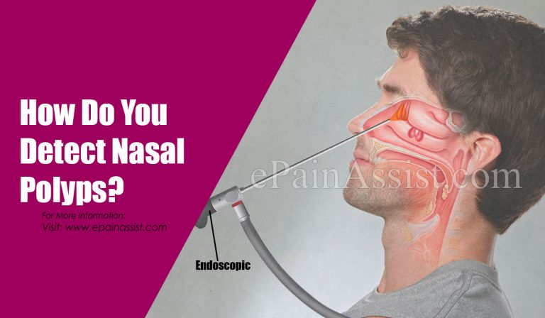 How Do You Detect Nasal Polyps & Can Nasal Polyps Bleed?