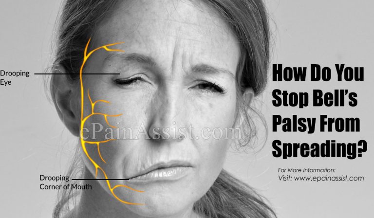 How Do You Stop Bell’s Palsy From Spreading?