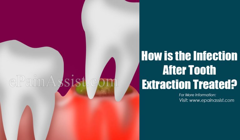 How is the Infection After Tooth Extraction Treated & What Are the Precautions to take to Avoid Infections After Tooth Extraction?