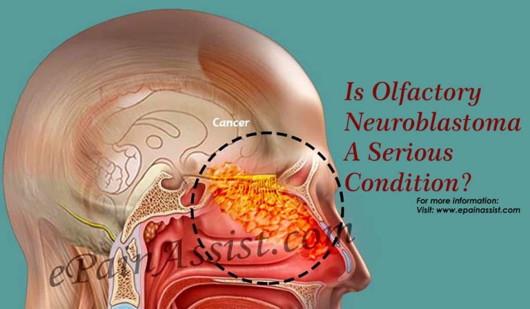 Is Olfactory Neuroblastoma A Serious Condition & Can It Be Reversed