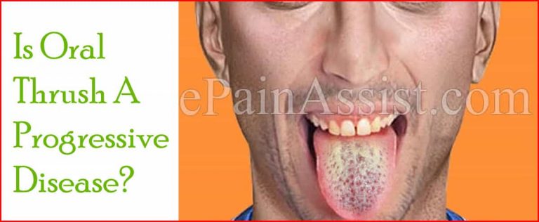 Is Oral Thrush A Progressive Disease & Alternative Treatments For It?