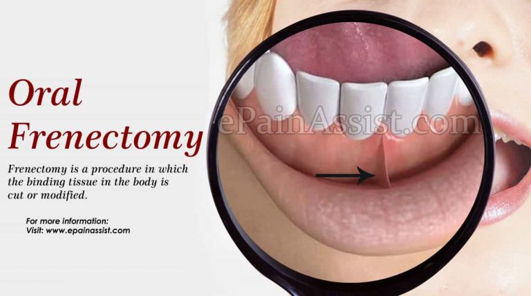 Oral Frenectomy: Types & Recovery