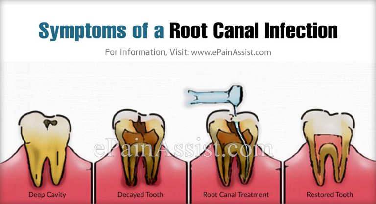 What Are Root Canal Infections, Know its  Causes, Symptoms, Prevention