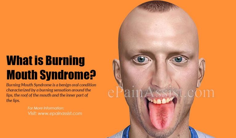 What Causes Burning Mouth Syndrome?