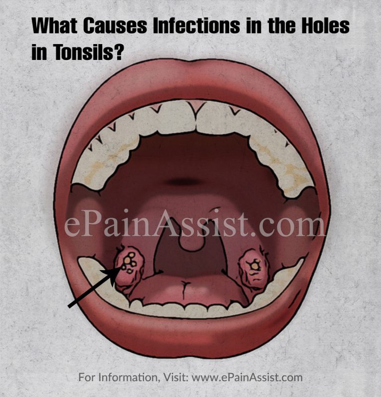What Causes Infections in the Holes in Tonsils & How is it Treated?