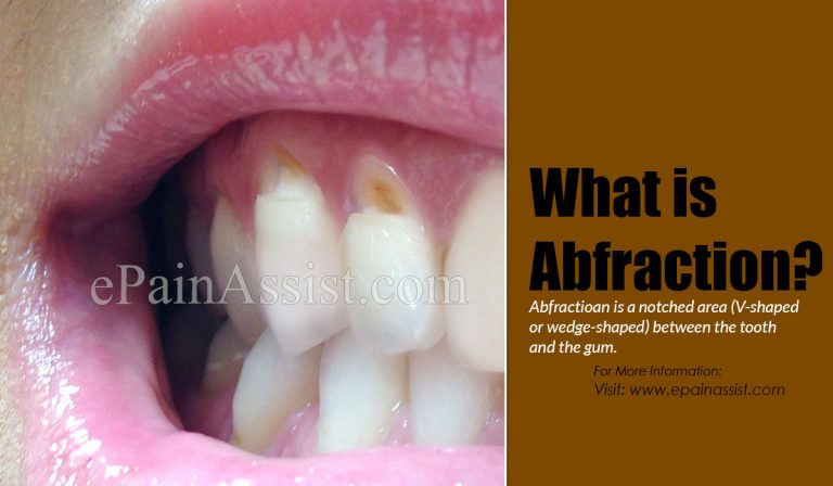 What is Abfraction & How is it Treated?|Causes, Symptoms, Diagnosis of Abfraction