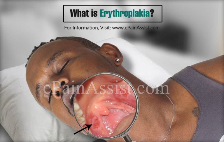 What is Erythroplakia & Is It Cancerous? | Symptoms, Detection, Treatment of Erythroplakia