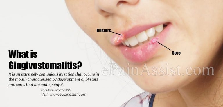 What is Gingivostomatitis: Causes, Symptoms, Treatment, Diagnosis