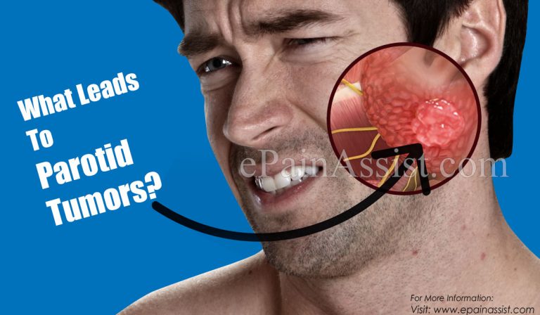 What Leads To Parotid Tumors & Can It Be Cured?