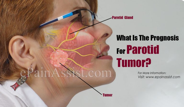 What Is The Prognosis For Parotid Tumor & Lifestyle Changes For It?
