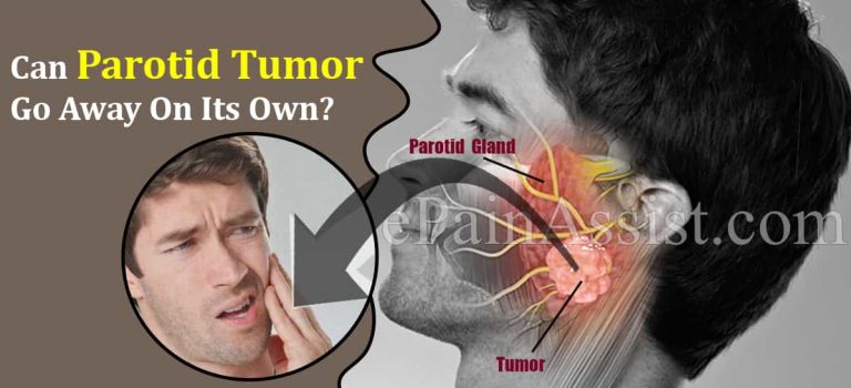 Can Parotid Tumor Go Away On Its Own & What Are Its Natural Remedies?