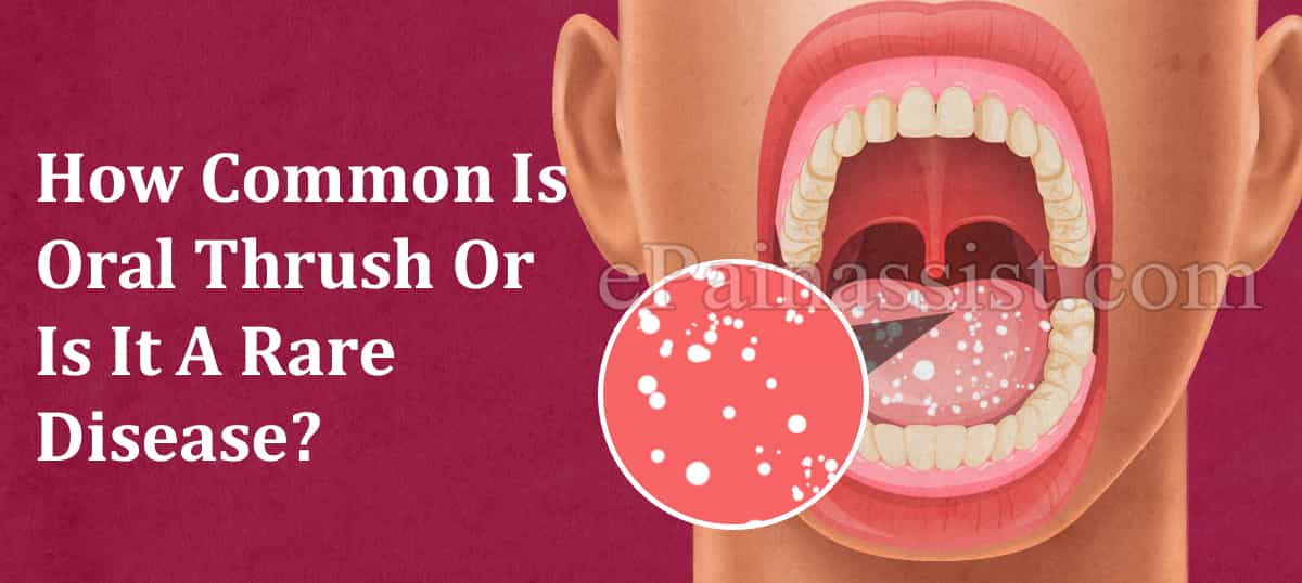 How Common Is Oral Thrush Or Is It A Rare Disease?