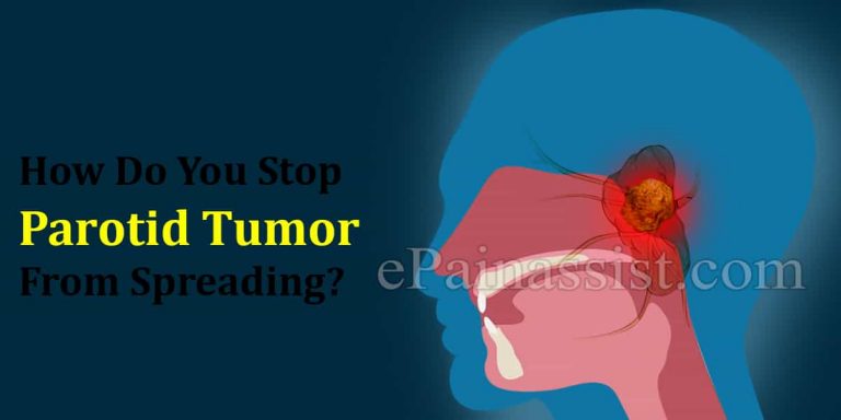 Can You Die From Parotid Tumor & How Do You Stop It From Spreading?