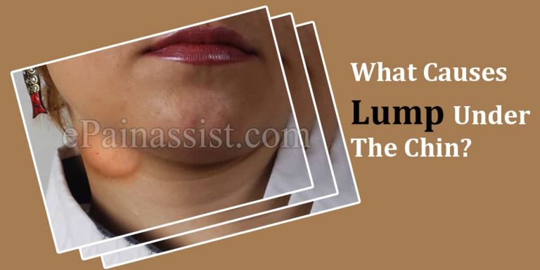 Lump Under The Chin: Causes & Treatment Options